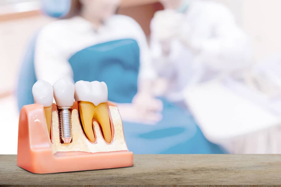 Dudas comunes sobre el proceso de implantología